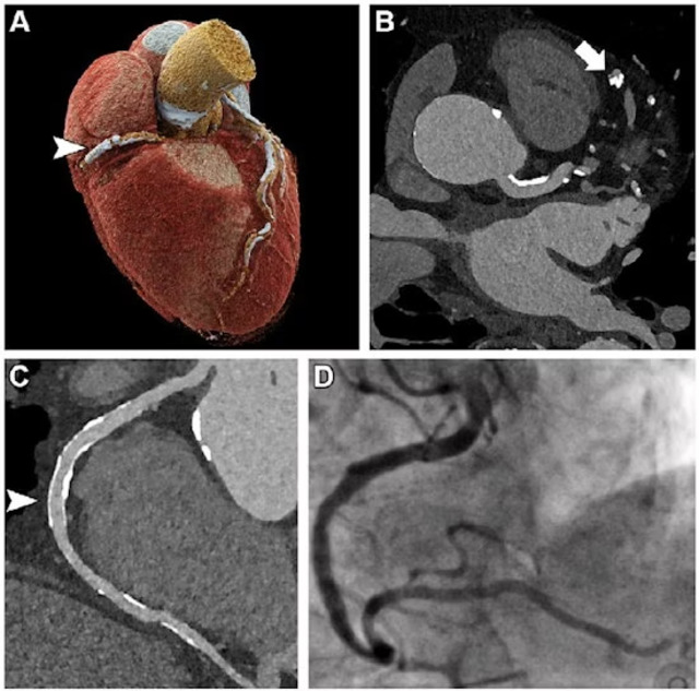 20230620PCCT Cardiac